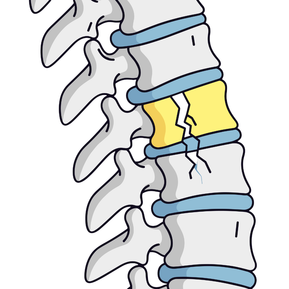 fractura vertebral