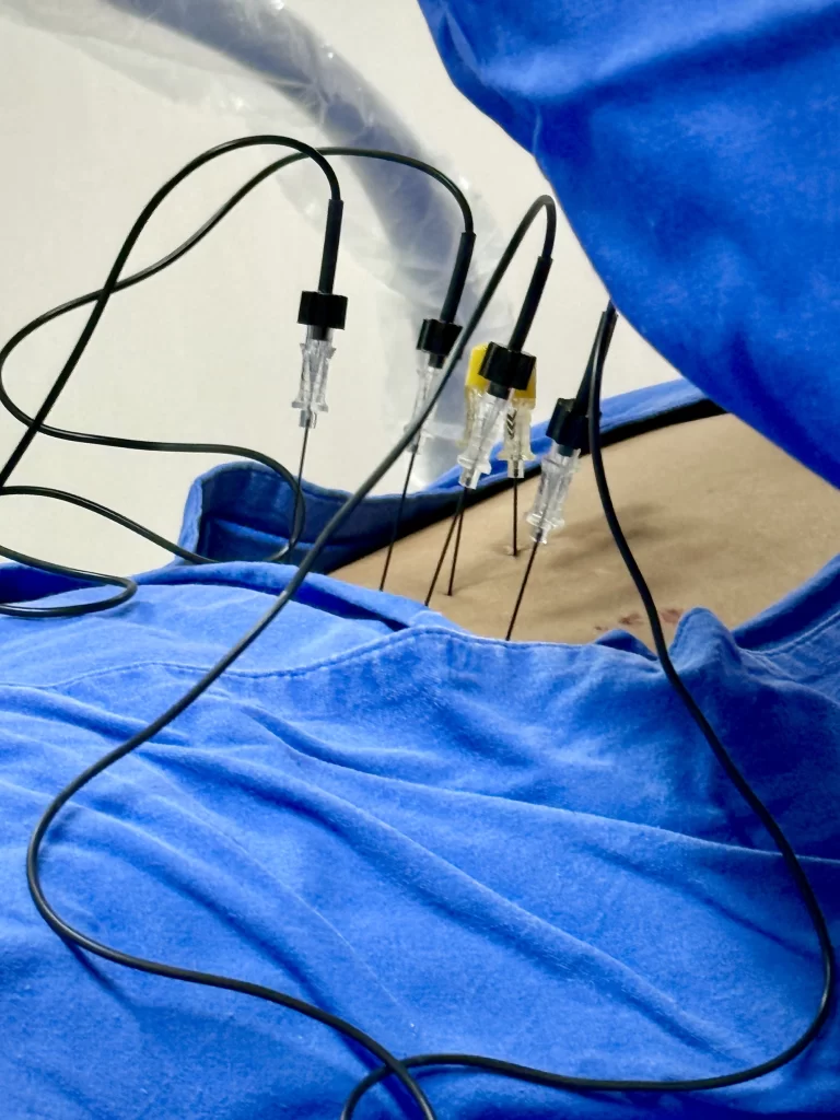 radiofrecuencia en columna