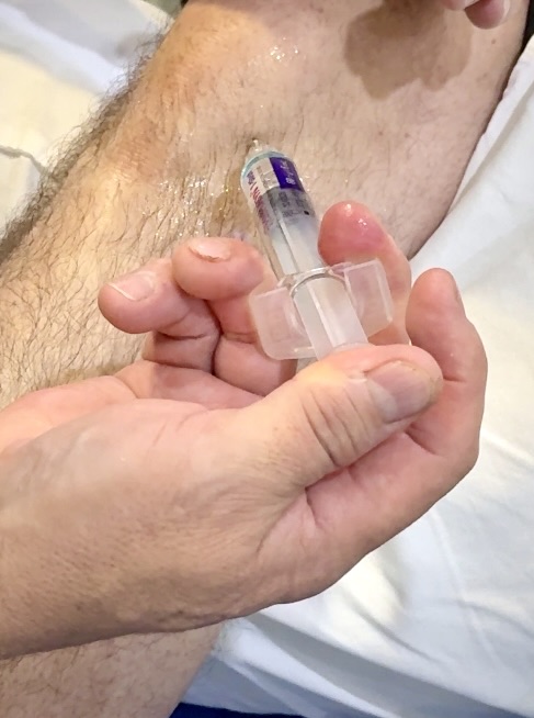 viscosuplementacion de rodilla